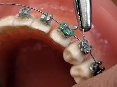 FORO SUPER POP : Color de los brackets