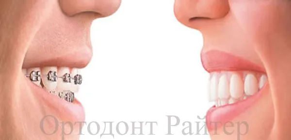 Фото брекеты до и после исправления