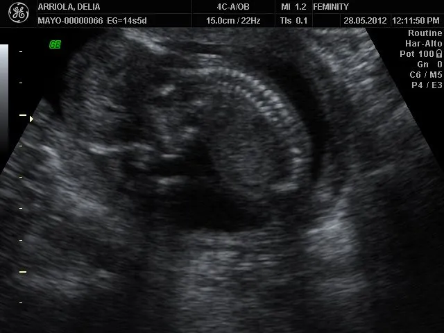 Ultrasonidos de bebés imagenes - Imagui