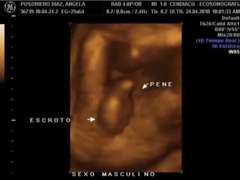 Fotos de eco en 3D de 17 semanas - Imagui