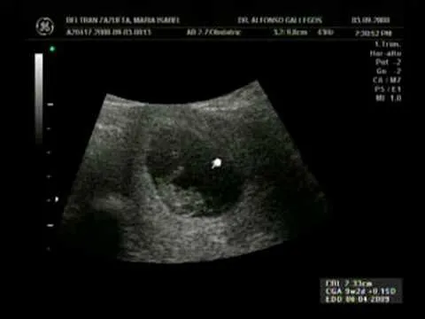 Fotos de ultrasonido de 1 mes - Imagui