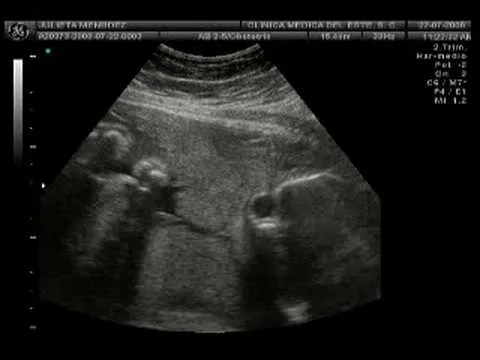 Ultrasonido de una niña - Imagui