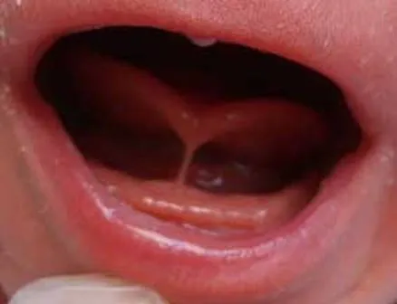 Frenillo sublingual o anquiloglosia | Momento Lullaby