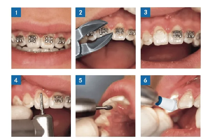 Fresa “AGK” para remover adhesivo de brackets | Bienvenido al Blog ... Fresa “AGK” para remover adhesivo de brackets | Bienvenido al Blog ...