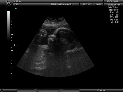 Fotos de ultrasonidos de 3 meses - Imagui