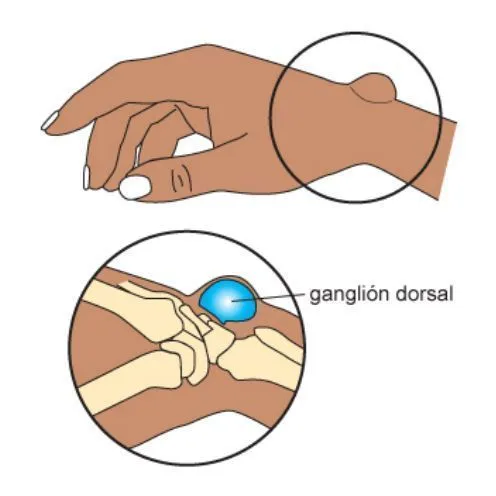 El ganglión en la muñeca, común en pianistas e instrumentistas de ... El ganglión en la muñeca, común en pianistas e instrumentistas de ...