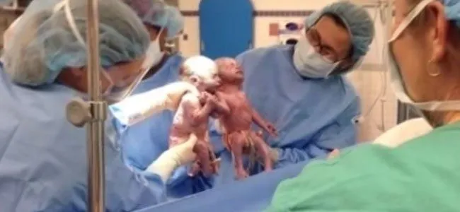Las gemelas que nacieron agarradas de la mano Las gemelas que nacieron agarradas de la mano