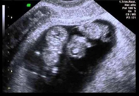 tengo gemelitos :) - Bebés de Marzo 2015 - BabyCenter tengo gemelitos :) - Bebés de Marzo 2015 - BabyCenter
