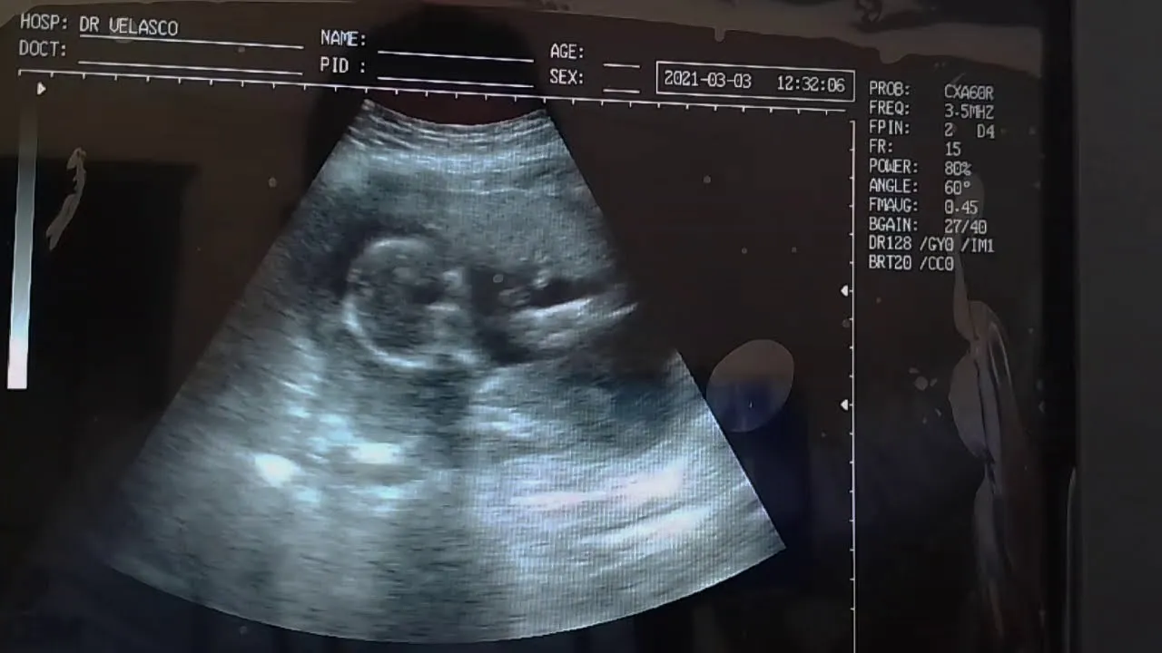 GEMELOS DE 17 SEMANAS DE GESTACIÓN AMBOS CON BUENA MOTILIDAD FETAL - YouTube GEMELOS DE 17 SEMANAS DE GESTACIÓN AMBOS CON BUENA MOTILIDAD FETAL - YouTube