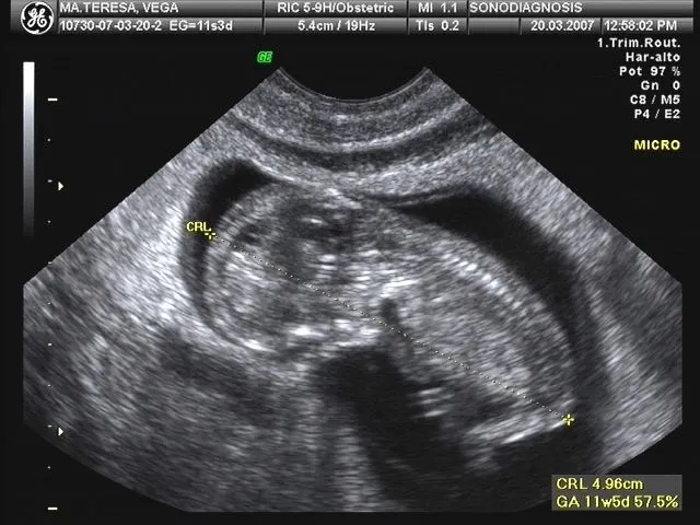 Imagenes de ultrasonidos de embarazo de 1 mes - Imagui