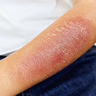 Golpes y heridas en los niños