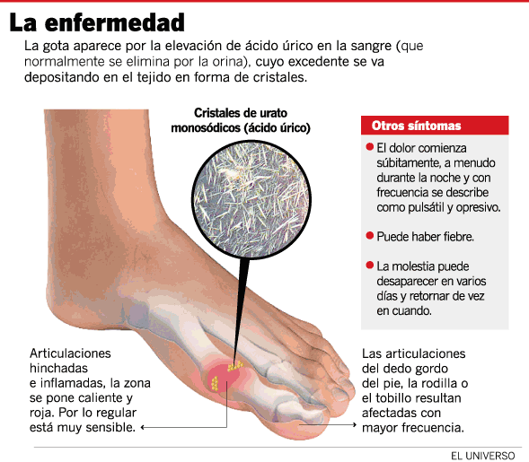 La gota, una afección muy dolorosa | Pregunta a tu farmacéutico