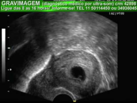 GRAVIMAGEM 2099 (ULTRASSOM GRAVIDEZ 5 SEMANAS E MEIA).mp4 - YouTube
