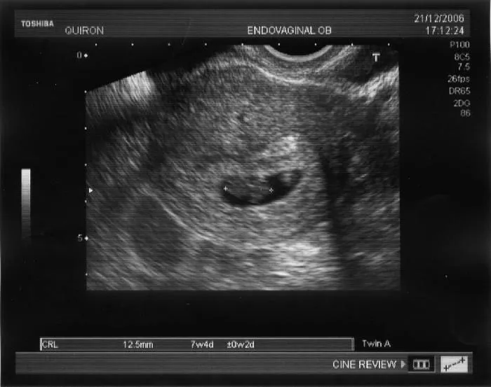 Como esta un bebé de 4 semanas de gestacion - Imagui Como esta un bebé de 4 semanas de gestacion - Imagui