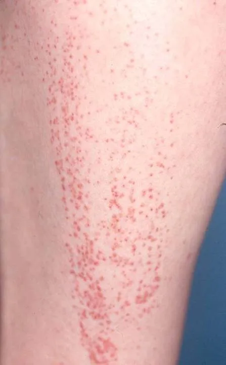 Henoch-Schönlein Purpura - Types of Vasculitis