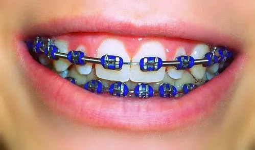 Colores de ligas de brackets para hombre - Imagui