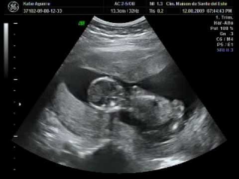 Ecografía Mellizos de Kattie y Pepe (13 Semanas) Parte I - YouTube