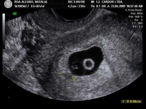 Fotos de 7 semanas de embarazo - Imagui