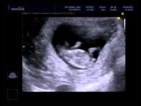 2 Meses y Medio de embarazo Miriam y Alfredo! - YouTube 2 Meses y Medio de embarazo Miriam y Alfredo! - YouTube