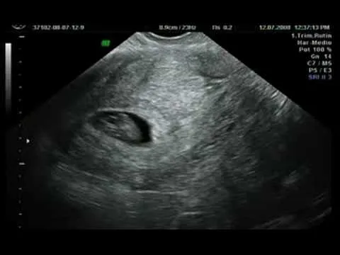 Imagenes de ecografia de 2 semanas - Imagui Imagenes de ecografia de 2 semanas - Imagui