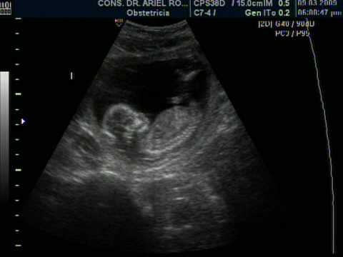 EMBARAZO DE 15 SEMANAS. DR ARIEL RODRIGUEZ, UNION MEDICA, SANTIAGO ...