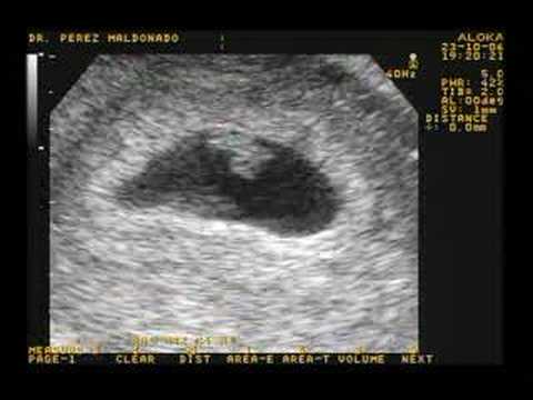 Ecografia bebé 6 semanas - Imagui