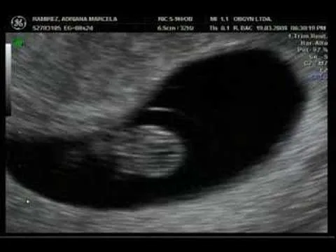 Fotos de ultrasonidos de 8 semanas - Imagui Fotos de ultrasonidos de 8 semanas - Imagui