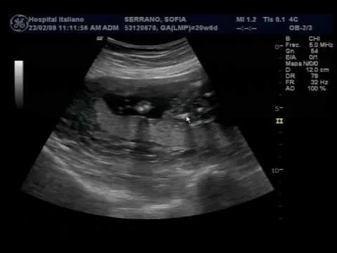 Ecografia de una niña de 20 semanas - Imagui