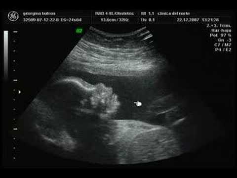 Ultrasonido de niña de 5 meses - Imagui
