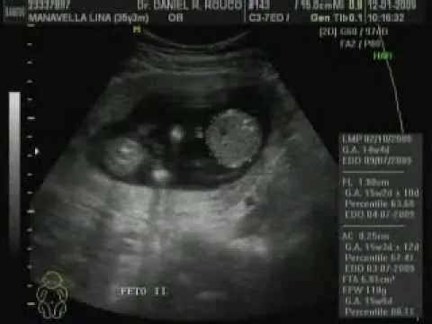 Sonograma de gemelos - Imagui
