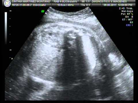 Sonograma de bebé de 7 meses - Imagui