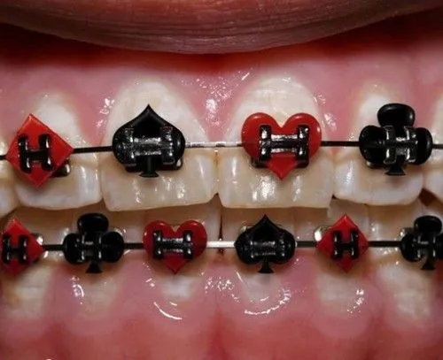 Imagenes colores de brackets bonitos - Imagui Imagenes colores de brackets bonitos - Imagui