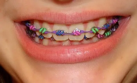 Imagenes de brackets de colores