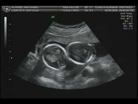 Eco de gemelos de 4 meses - Imagui