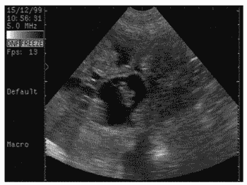 Ultrasonidos de 3 meses - Imagui