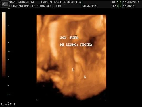 Ultrasonido de una niña - Imagui