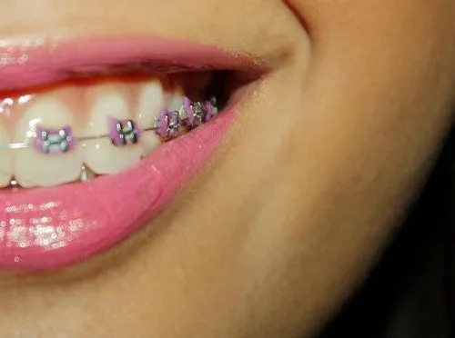 Brackets con ligas de Hello Kitty - Imagui