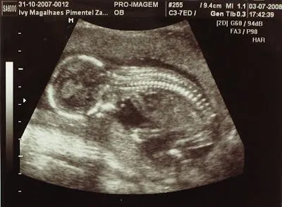 Clarissa com 16 semanas. Aqui ela já tinha crescido... estava com ... Clarissa com 16 semanas. Aqui ela já tinha crescido... estava com ...