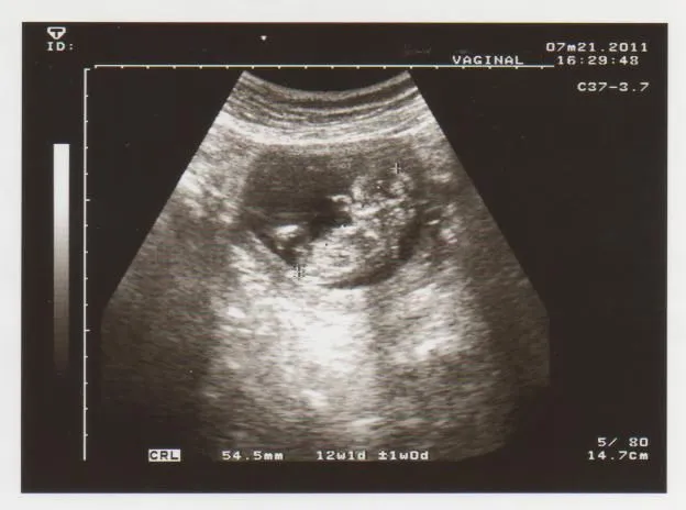 Ecografias de 1 mes de embarazo - Imagui