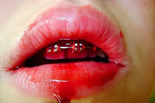 Labios con brackets tumblr - Imagui