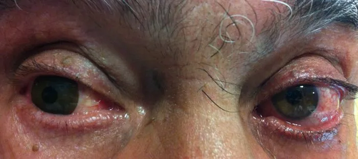 LENTES DE CONTACTO PROTÉSICAS - Optica Morató | Optica Morató LENTES DE CONTACTO PROTÉSICAS - Optica Morató | Optica Morató