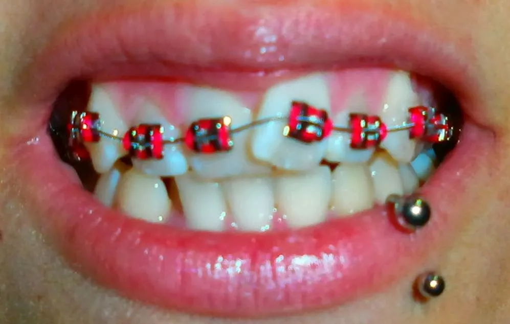 Brackets con ligas - Imagui