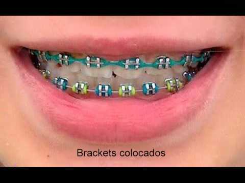 Colores de ligas para brackets mujer - Imagui