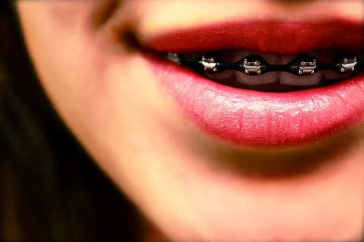 Ligas negras | Brackets *-* | Pinterest