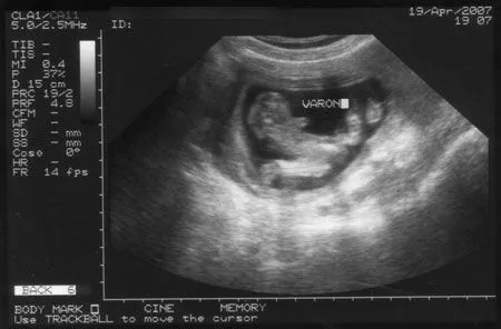 Ecografias de 1 mes - Imagui