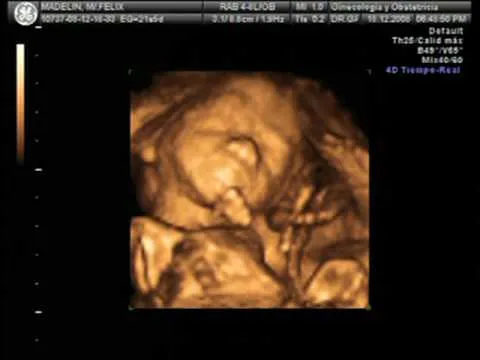 Madelyn Felix,Ecografia 20 semanas de embarazo - YouTube Madelyn Felix,Ecografia 20 semanas de embarazo - YouTube