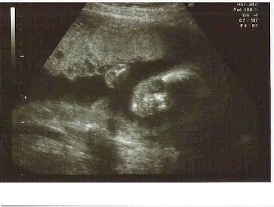Mis mamás me miman: La famosa ecografía de las 20 semanas Mis mamás me miman: La famosa ecografía de las 20 semanas