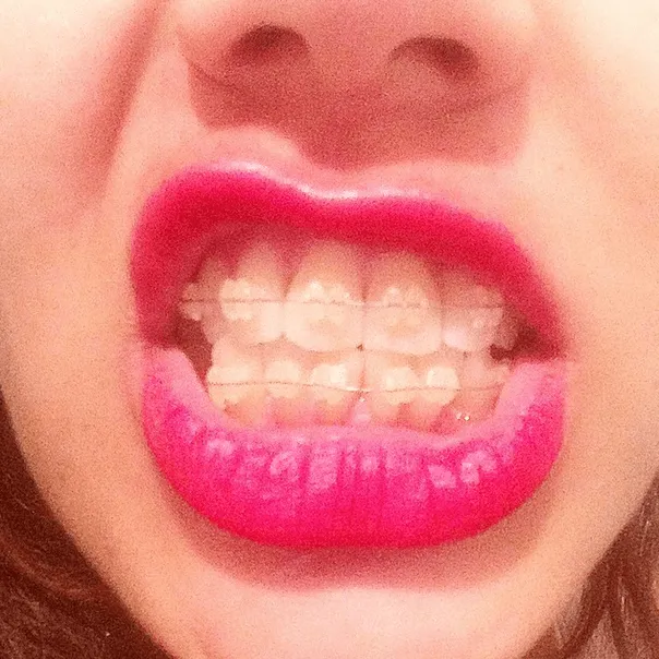 Cómo maquillo mis labios si tengo Brackets? - Geek&Chic