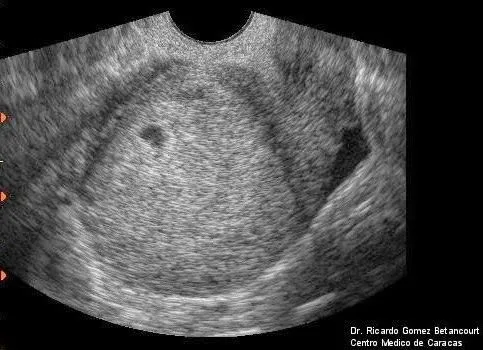 MATERNIDAD Y PSICOLOGÍA ☼: ECOGRAFIAS POR SEMANAS. Imágenes