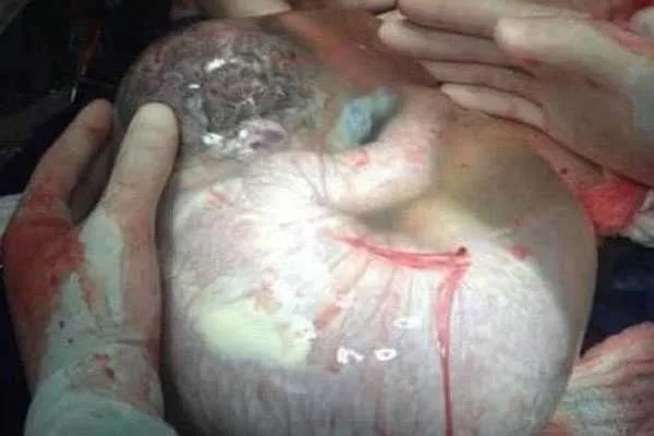 Médico comparte foto de recién nacido todavía dentro de la bolsa ...